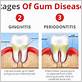 degenerative gum disease