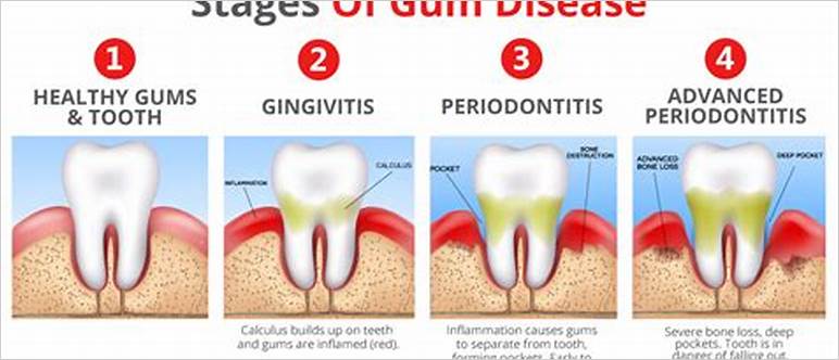 fighting gingivitis and gum disease