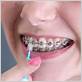 interdental toothbrush for braces