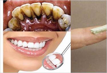 teeth black stain removal at home