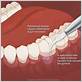 treatment of periodontal disease